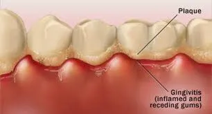 Close-up of teeth showing plaque accumulation along the gumline